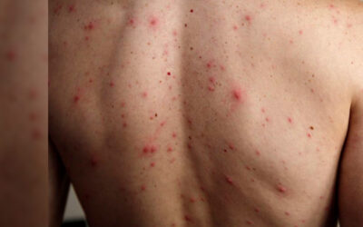 NUEVO CASO DE SARAMPIÓN ACTIVÓ CERCO SANITARIO EN LA CAPITAL POTOSINA