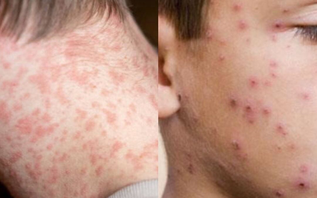 GOBIERNO DEL ESTADO REFUERZA CAMPAÑA INFORMATIVA SOBRE SARAMPIÓN Y VIRUELA