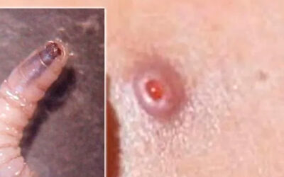 SUBEN CASOS DE MIASIS POR GUSANO BARRENADOR EN HUMANOS EN LA HUASTECA